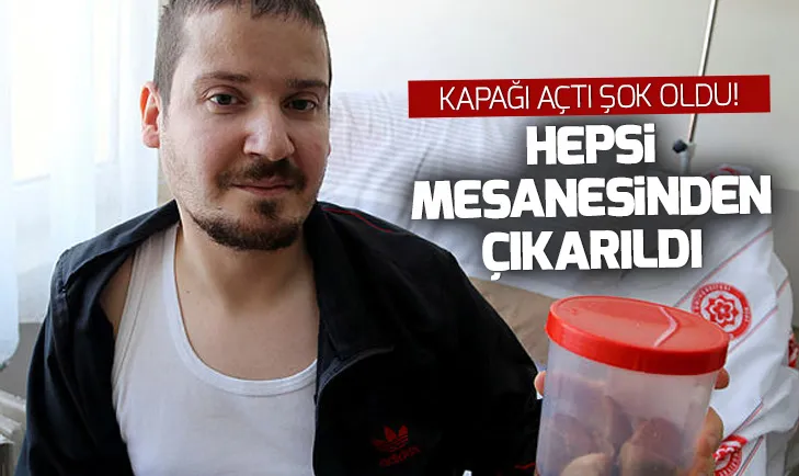 Sivasta şaşırtan olay! Hepsi mesanesinden çıkarıldı