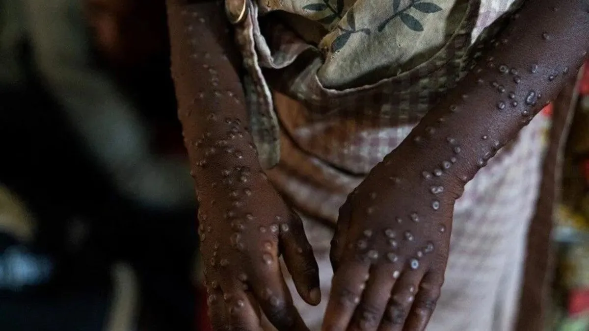 Kongo Demokratik Cumhuriyeti'ne 50 bin doz M çiçeği virüsü aşısı!