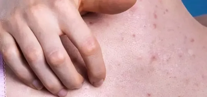 Sırtta çıkan sivileler neyin habercisidir? Meğerse sebebi...