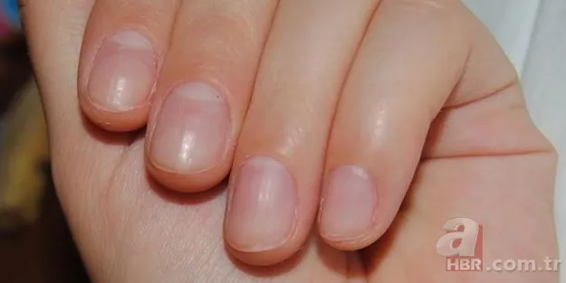 Tırnak diplerinizi kontrol edin! Belki de bu hastalıklardan birine sahipsiniz... 11