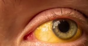 Uzmanı açıkladı: Sarı nokta hastalığının sonunda körlüğe giden durumlar oluşuyor