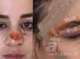 Şarkıcı ve oyuncu Zeynep Doruk dehşeti yaşadı! Köpekler saldırdı: Yüzü tanınmaz hale geldi 3
