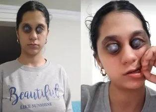 Sosyal medyada fotoğrafını görenler photoshop sanıyor! Genç Ümran’ın gözleri doğuştan…