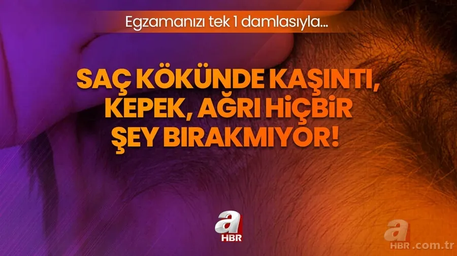 Egzamanızı tek 1 damlasıyla tarihe gömüyor! Saç kökünde kaşıntı, kepek, ağrı şikayetiniz varsa... 1