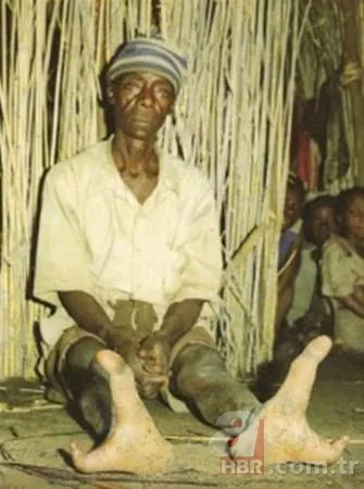 Dünyanın en tuhaf hastalıkları 24