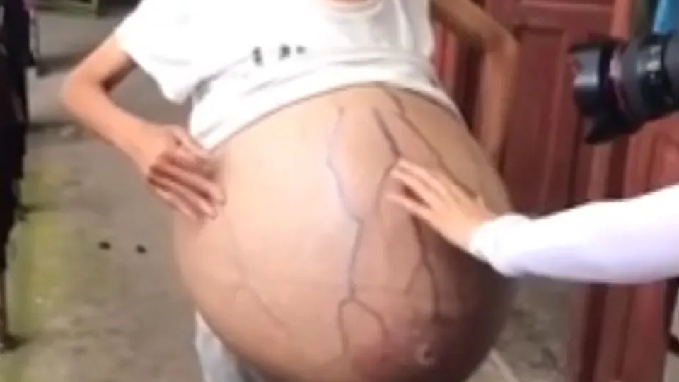 Son dakika: Tıp dünyası şokta! Aniden karnı şişti! Genç kadındaki 20 kiloluk kütlenin gizemi çözülemiyor