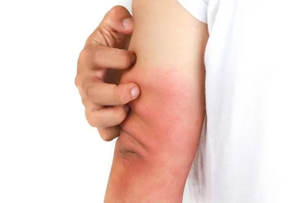 Egzama nasıl geçer? Egzama nedenleri ve belirtileri...