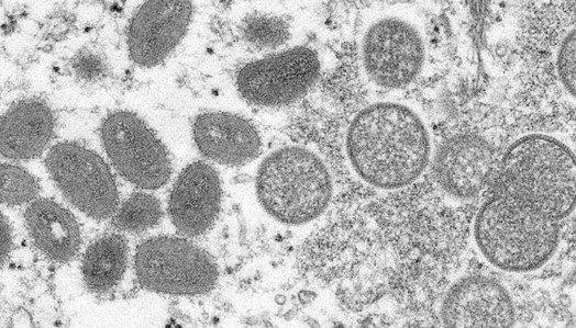 Maymun çiçeği virüsü nedir? Türkiye’de görüldü mü? Maymun çiçeği hastalığı nasıl bulaşır, belirtileri neler?