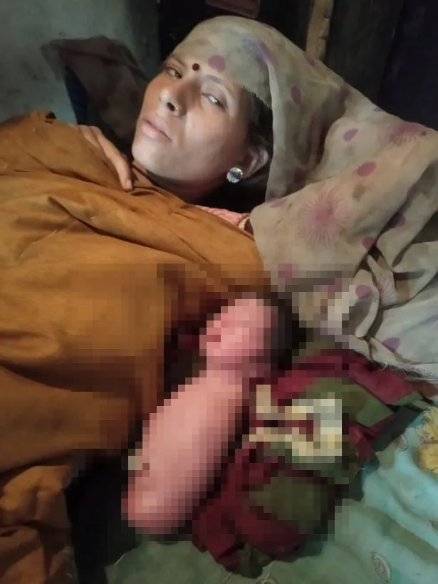 Hindistan'da kolları ve bacakları olmadan doğan bebek doktorları şoke etti - 2