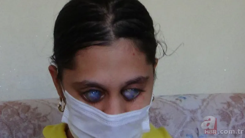 Sosyal medyada fotoğrafını görenler photoshop sanıyor! Genç Ümran’ın gözleri doğuştan… 1