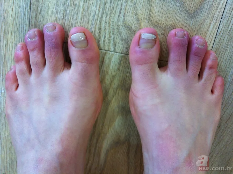 Chilblains ne demek? Chilblains hastalığı belirtileri neler? Galatarasaylı Seri'nin hastalığı Chilblains nedir? 8