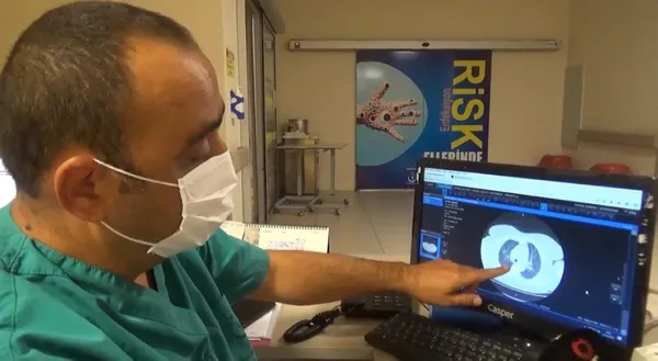 Korona hastalarının ciğerleri dehşete düşürdü - 2