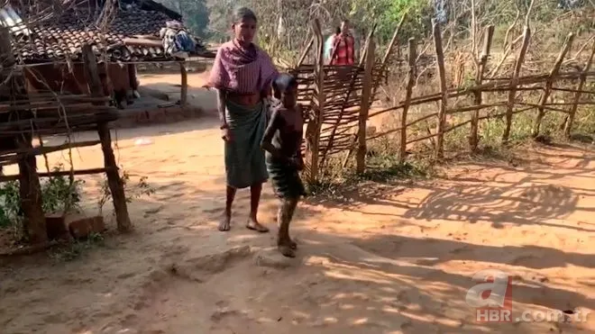 Vücudu her geçen gün taşa dönüşüyor! 7