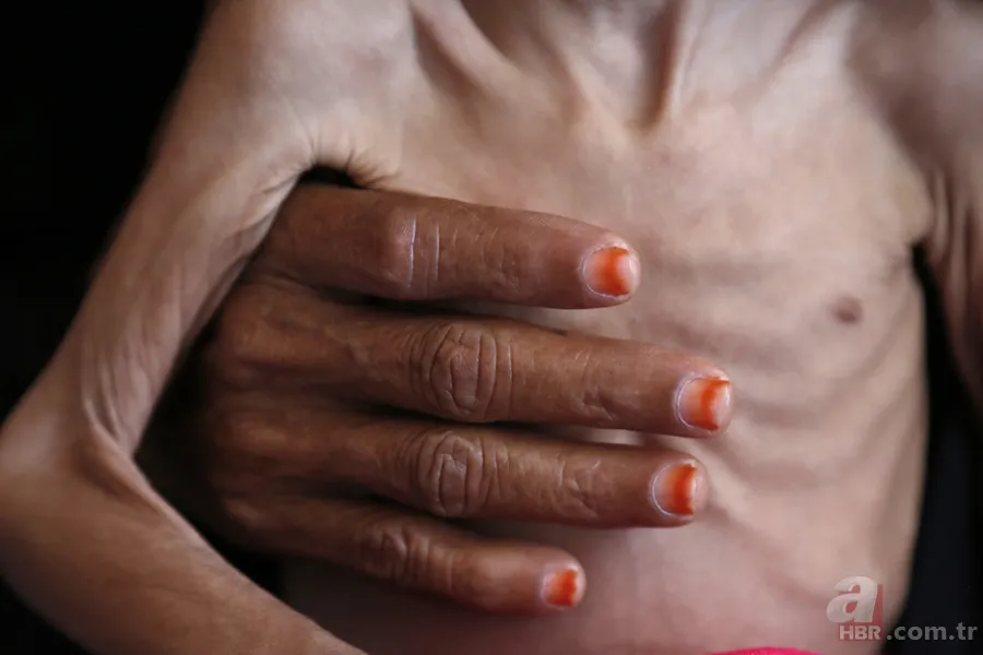 Kolera nedir, nasıl bulaşır? O ülkede ölü sayısı giderek artıyor: UNICEF uyardı! Tedavisi var mı, belirtileri neler? 1