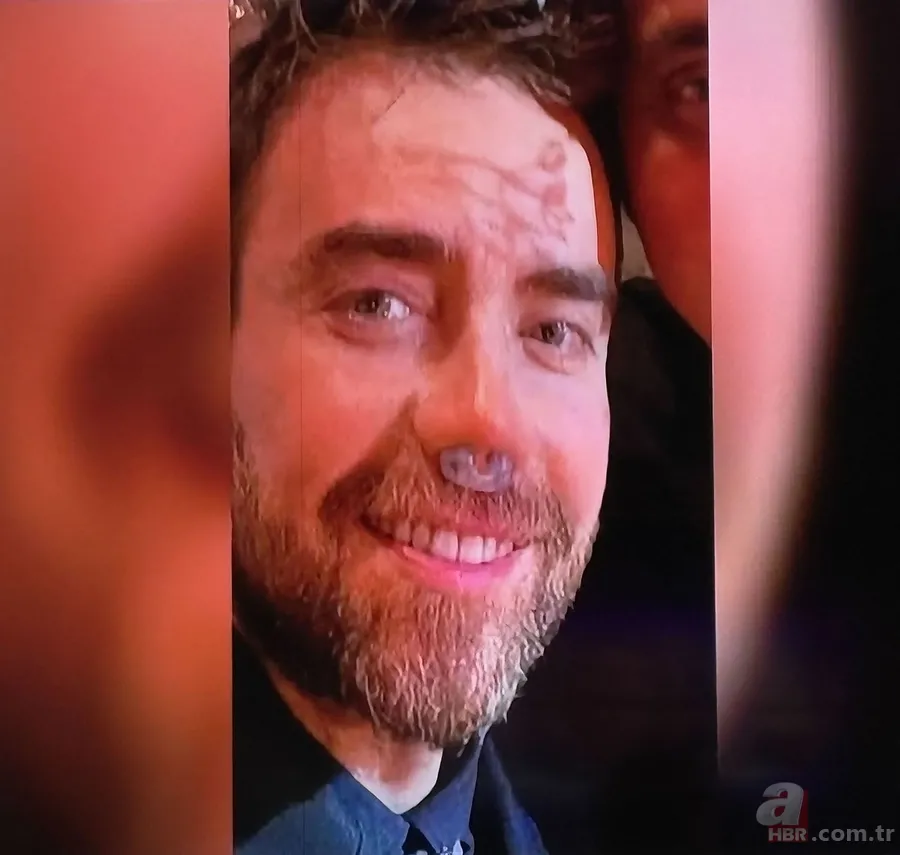 12. kez burun ameliyatı olan Murat Dalkılıç'ın son hali ortaya çıktı 5