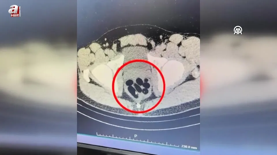 Kadının midesinden çıktı! Gözaltına alındı