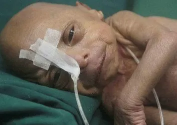 Bangladeş'te yaşlı bebek doğdu!