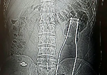 Karaman’da karın ağrısı şikayetiyle hastaneye gitti kalın bağırsağında soda şişesi çıktı