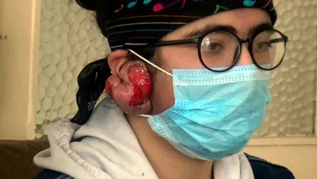 Erzincan’da “Keloid” teşhisi konan genç kız tedavi olmazsa duyamayacak! Keloid nedir? - 4