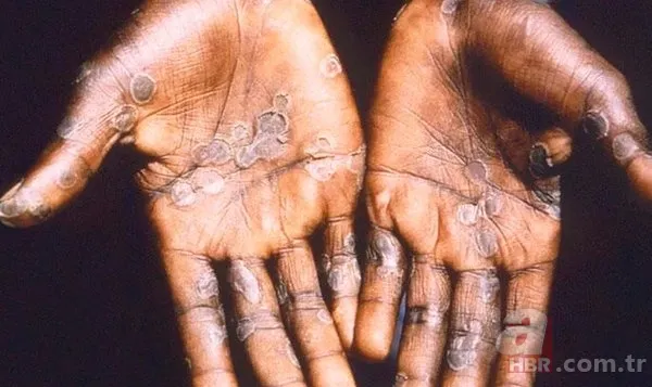 Maymun çiçeği virüsü Türkiye'de var mı? Sağlık Bakanı Fahrettin Koca açıkladı! Maymun çiçeği hastalığı belirtileri nedir? 8