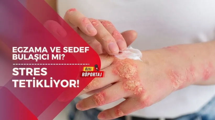 Egzama ve sedef bulaşıcı mı? Stres cildinizi etkiliyor! Dermatoloji uzmanı açıkladı