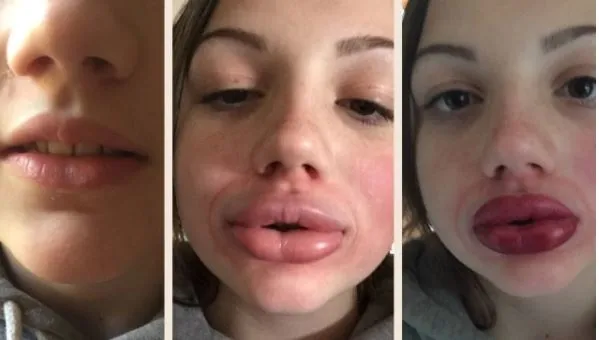 Estetik yaptıranlara korona aşısı uyarısı! Dolgusu olanlarda iltihap yapıyor