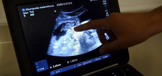 Portekiz’de yüzü olmayan bebek dünyaya geldi! Doğum uzmanı doktor açığa alındı