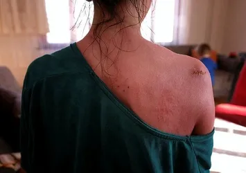 Kocası kaynar suyla haşlamıştı! Rukiye Ay'ın sözleri yürek dağladı