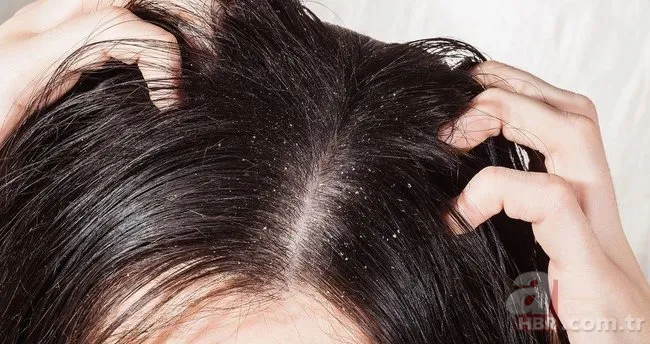 Egzamanızı tek 1 damlasıyla tarihe gömüyor! Saç kökünde kaşıntı, kepek, ağrı şikayetiniz varsa... 6