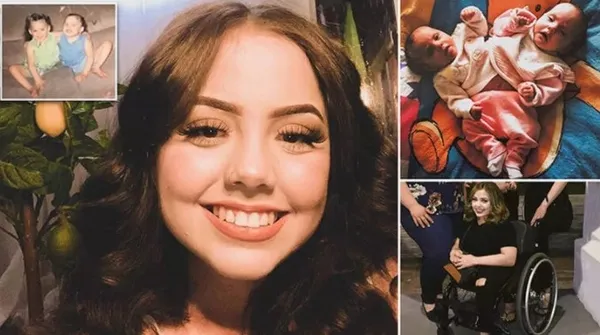 Kaybettiği yapışık ikizinin hayalini gerçekleştirdi! Hikayeleri Yürek bukrtu