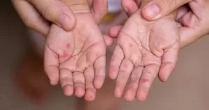 Uzmanı uyardı: ’Okullarda hızla yayılıyor’