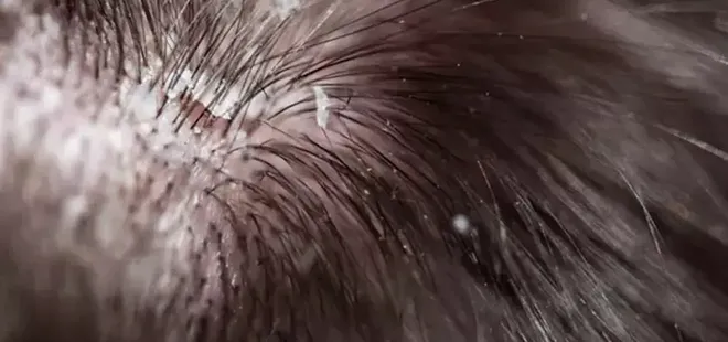 1 damlası saç derisini tertemiz yapıyor! Kaşıntı, kepek ve egzamayı geçiren yöntem...