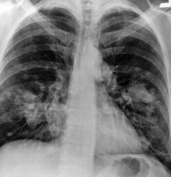 karin-agrisi-sikayetiyle-gitti-doktor-bile-sasirdi-hic-kimsenin-yapamayacagi-bir-sey-midesinden-63-tane-1685976169492.jpg 'Hiç kimsenin yapamayacağı bir şey' Doktor bile şaşırdı! Karın ağrısı şikayetiyle gitti! Midesinden 63 tane... - 4