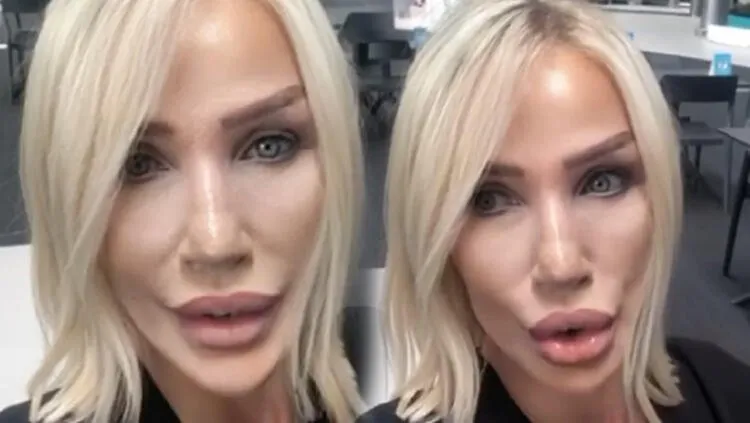 seda sayan in son hali saskina cevirdi estetik sonrasi