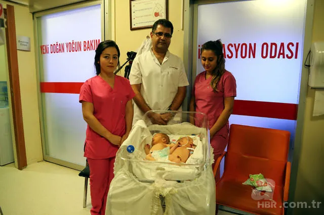 Yapışık ikizler dünyaya geldi 3