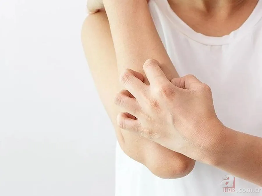 Bu belirtiler varsa dikkat! Ciltte geçmeyen kaşıntı kızarıklık... Uyuz neden olur, tedavi yöntemi nelerdir? Hastalık tanısı... 10