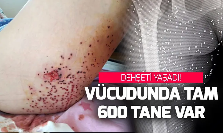 Genç kadın vücudunda 600 saçmayla yaşıyor!