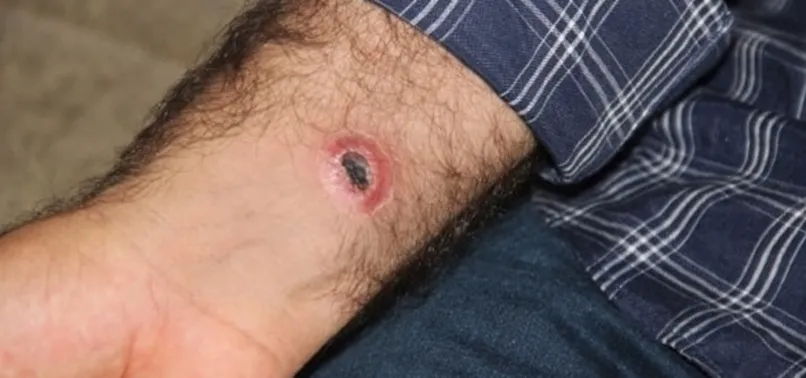 Endonezya'da 27 kişi şarbona yakalandı