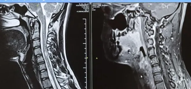 MS hastalığında erken teşhis hayat kalitesini arttırıyor