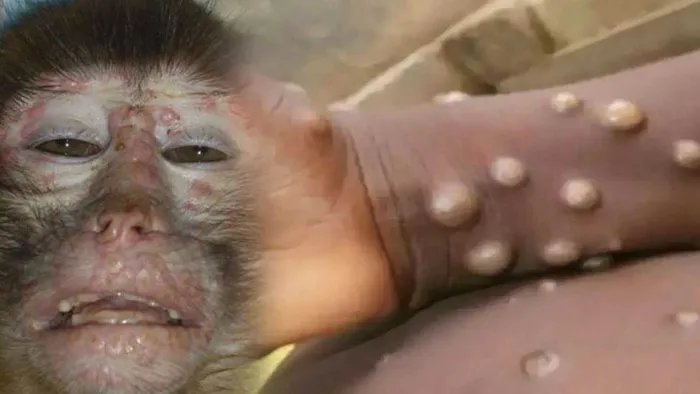 Dünyada maymun çiçeği alarmı: Vaka sayıları artıyor