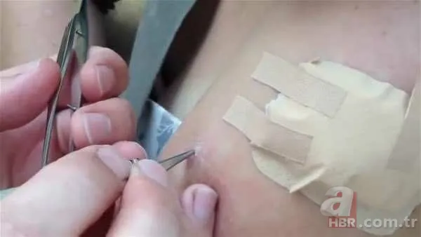 Genç kadının kolundan çıkanlar şoke etti 13