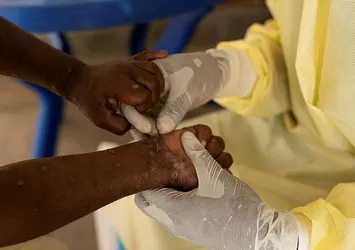 Dünyada maymun çiçeği virüsü alarmı! Pakistan'da 3 kişide M çiçeği virüsü tespit edildi