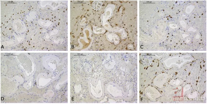 Felç riski COVID-19 aşısıyla artıyor mu? 100 binden fazla kişide görüldü: 17 ay hücrelerde birikerek... 4