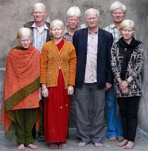 Dünyanın en büyük ’albino’ ailesi!