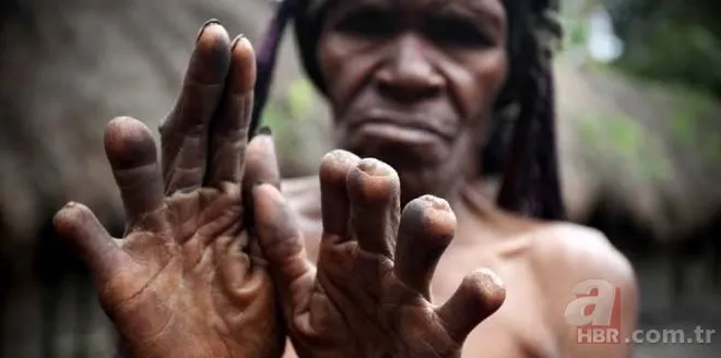 Dani Kabilesi’nin geleneği kadınların parmaklarını kestiriyor