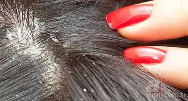 Kaşınan ve kepeklenen saçınız varsa dikkat! Bu yöntemle hem rahatlayacak hem de saçınızı uzatacaksınız 9