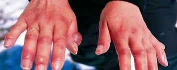 Chilblains ne demek? Chilblains hastalığı belirtileri neler? Galatarasaylı Seri'nin hastalığı Chilblains nedir? 10