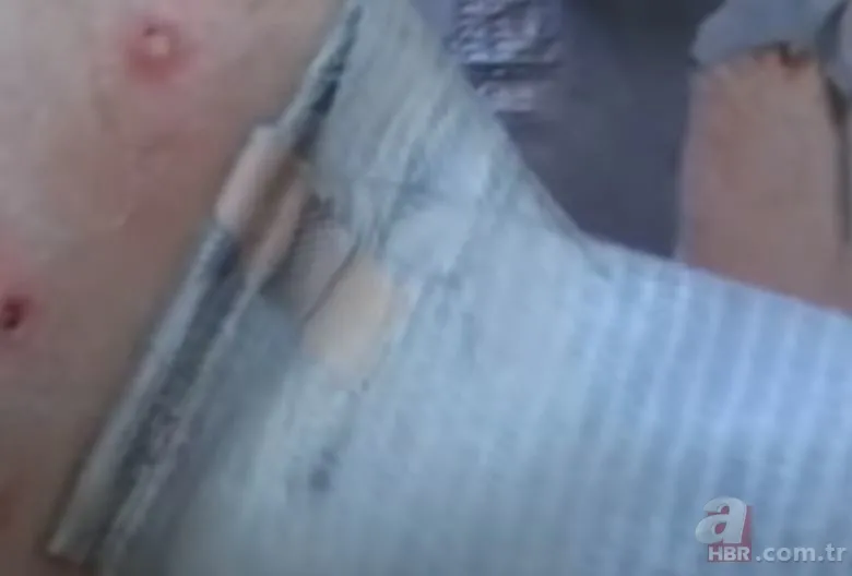 Sırtındaki yarayı sivilce zannetti ama gerçek dehşete düşürdü! Bakın içinden ne çıktı 14