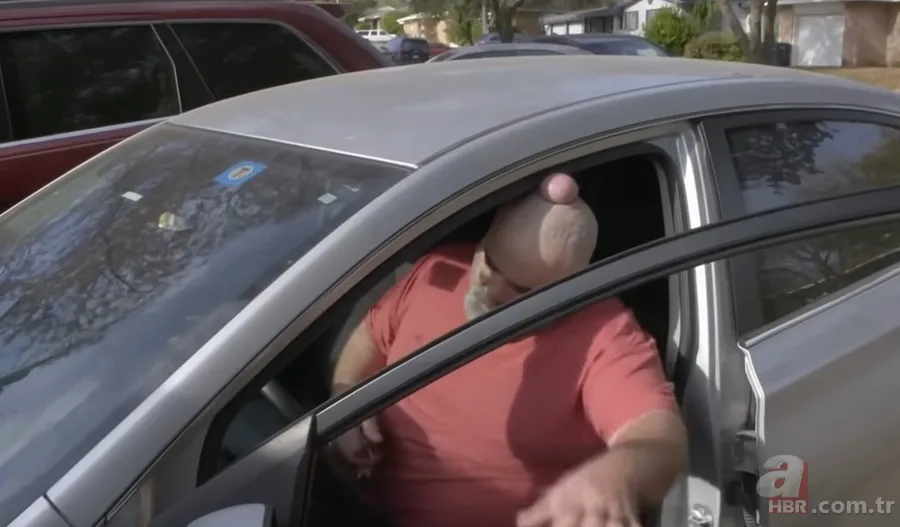 Sokağa şapka ile çıkıyordu! Başındaki şişlikten bakın ne çıktı 👩⚕️ Görenleri şaşkına çeviren olay 13