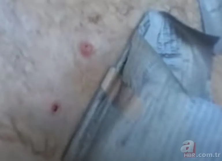 Sırtındaki yarayı sivilce zannetti ama gerçek dehşete düşürdü! Bakın içinden ne çıktı 12
